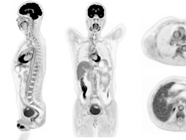 Coronal, sagittal, and axial slices from the first human scan on the uEXPLORER PET/CT scanner.